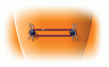 Eliminate Body Rattle